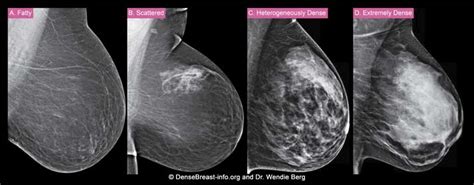 Breast cancer is a very rare cause of breast pain in males, though the condition may be more common than you might think. . Breast buds or fatty tissue